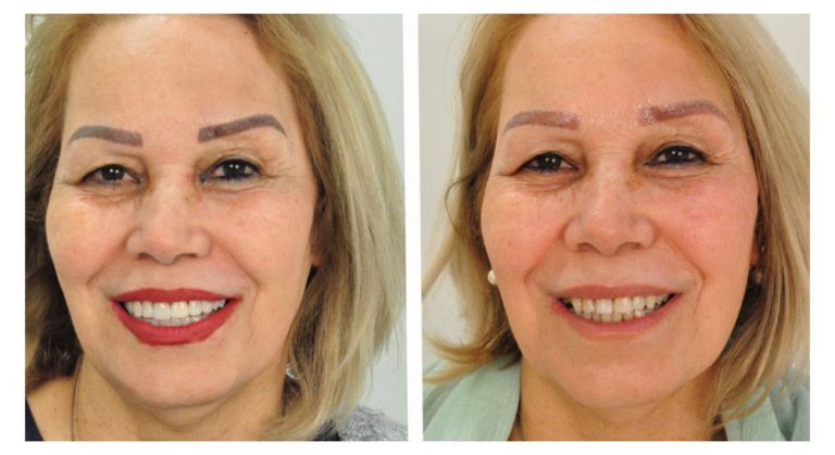 Composite Cosmetic Treatment