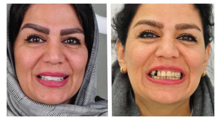 Laminate Dental Treatment