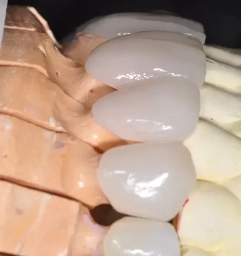 Hand crafted, highly translucent ceramic veneers before cementation.