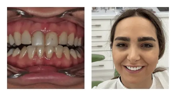 Your Smile with natural looking Ceramic veneers​