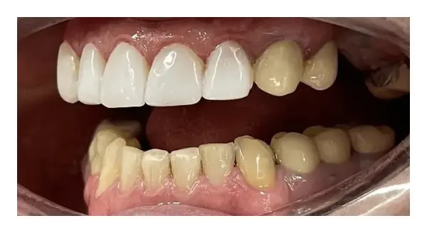 ceramic veneers for the upper teeth