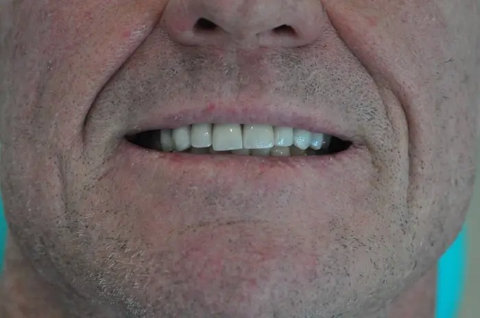 Ceramic crowns after