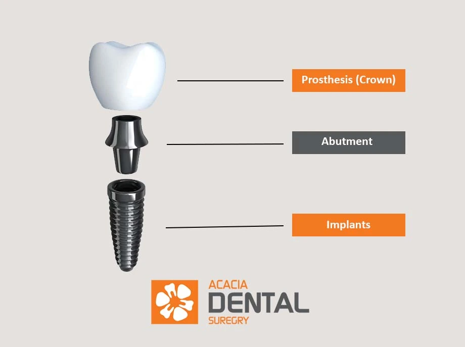 what is titanium implant