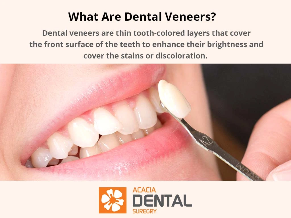 what is dental veneer definition