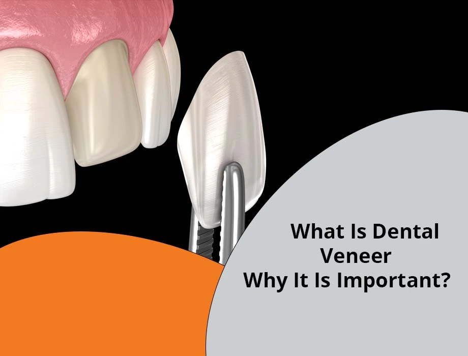 What Are Dental Veneers and Why Are They Important?