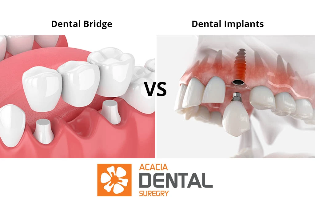 dental bridge vs dental implants