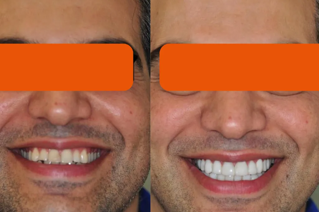 Teeth Veneer