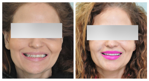 Cosmetic Veneers Treatment