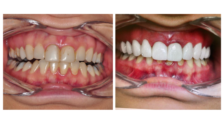 Porcelain veneers