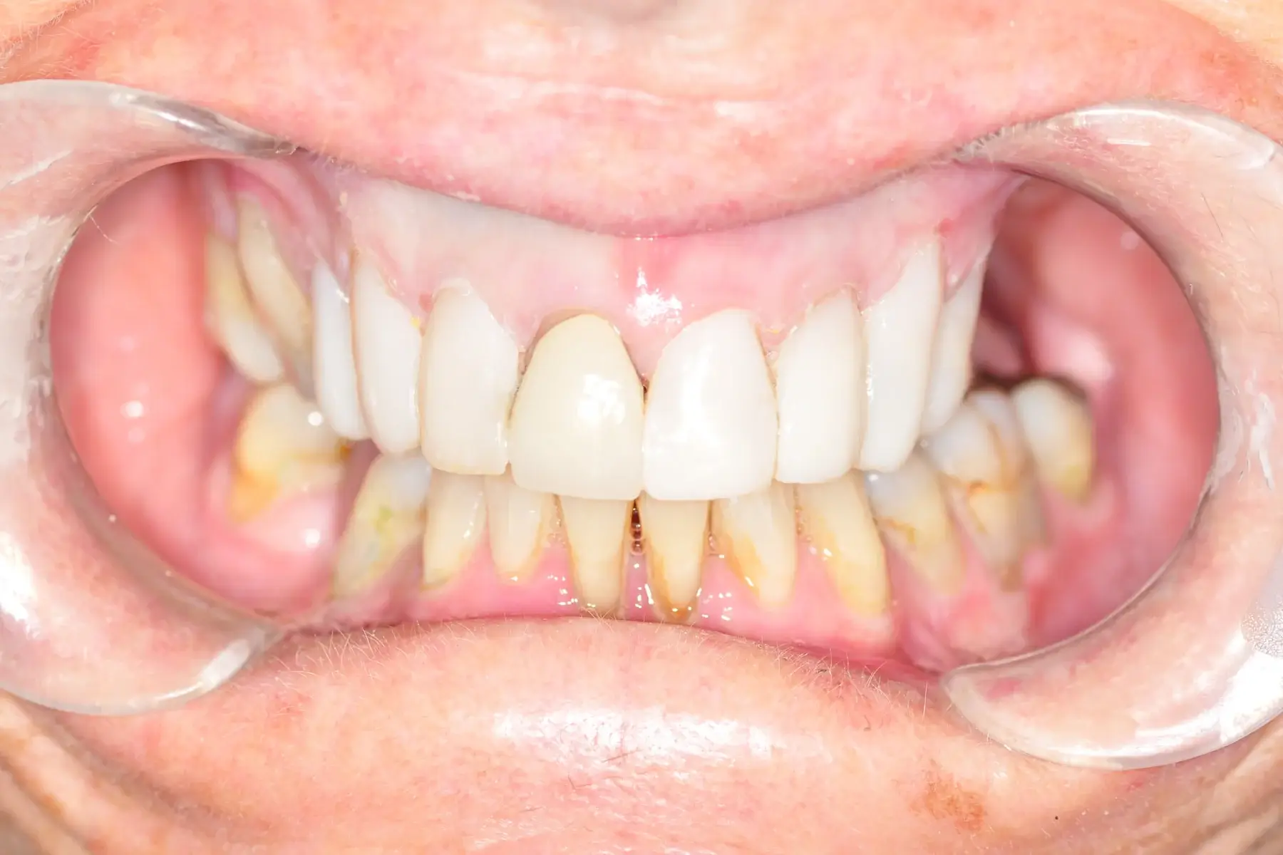 Acacia Dental After