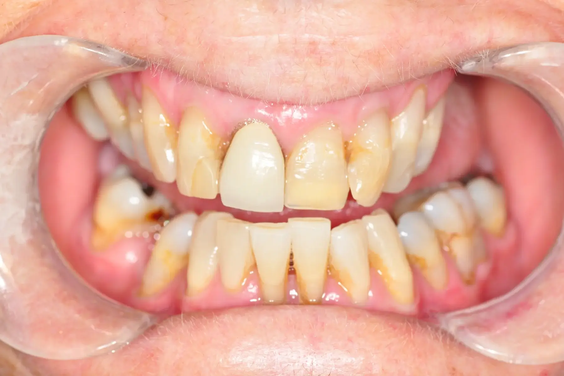 Acacia Dental Before 1