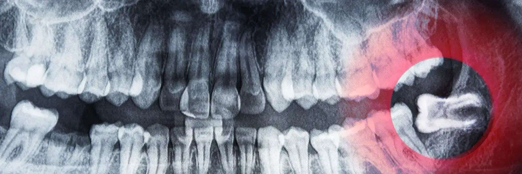Wisdom Teeth
