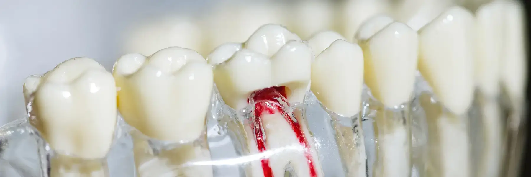Root Canal Darwin