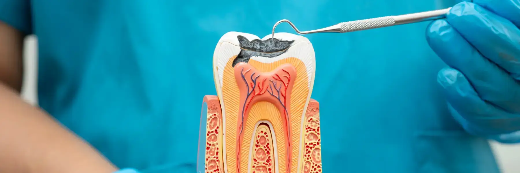 Root Canal Treatment