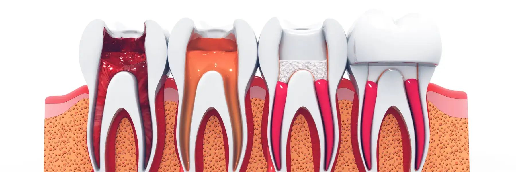 Root Canal